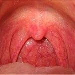 240px-Pharyngitis.jpg